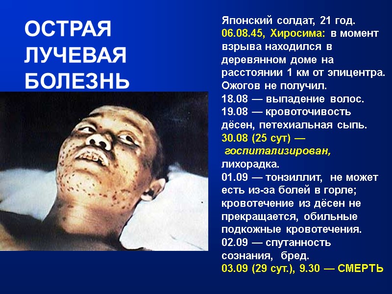 ОСТРАЯ  ЛУЧЕВАЯ  БОЛЕЗНЬ Японский солдат, 21 год. 06.08.45, Хиросима: в момент взрыва